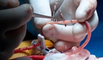 В Ульяновске впервые сделали операцию по аортокоронарному шунтированию сердца